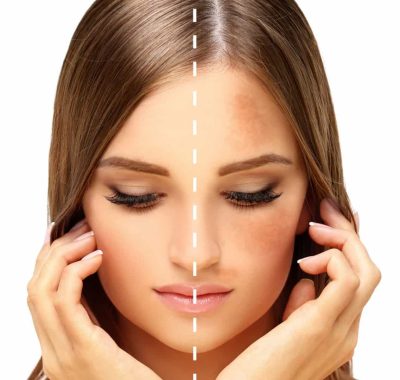 Melasma